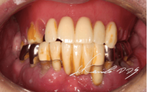 入れ歯が外れると不安