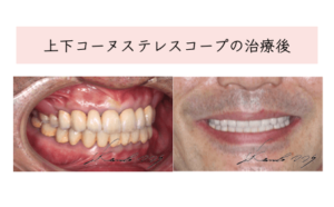 上下コーヌステレスコープの治療後