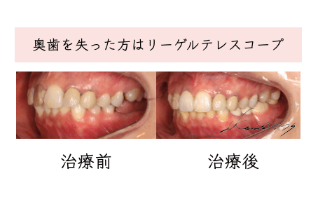 リーゲルテレスコープの治療前と治療後