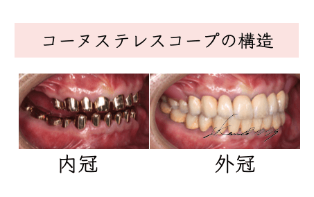 テレスコープ義歯(ドイツ式入れ歯)の構造