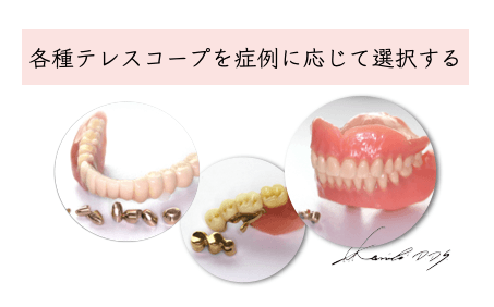 テレスコープ義歯(ドイツ式入れ歯)の様々な種類一覧