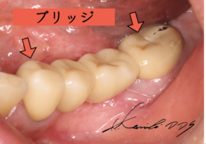 奥歯のブリッジがグラグラ