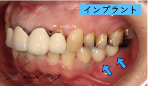 奥歯にインプラント