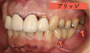奥歯のブリッジがグラグラでとれそう