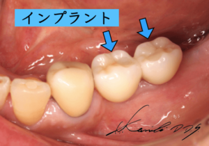 奥歯のインプラント