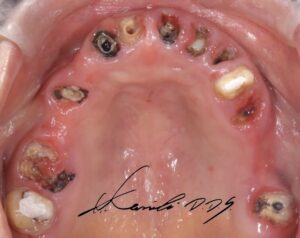 ブリッジの歯は虫歯、歯周病に罹患しており、歯の根が割れている