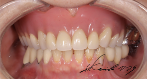 60代女性のインプラントが怖い方で入れ歯をしている方