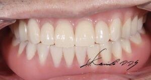 ブリッジが外れそう、グラグラしているという50代の男性にドイツ式入れ歯で治療した状態