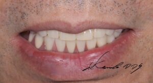 ブリッジが外れそう、グラグラしているという50代の男性にドイツ式入れ歯で治療した見た目