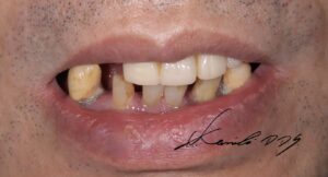 ブリッジが外れそう、グラグラしているという50代の男性の見た目