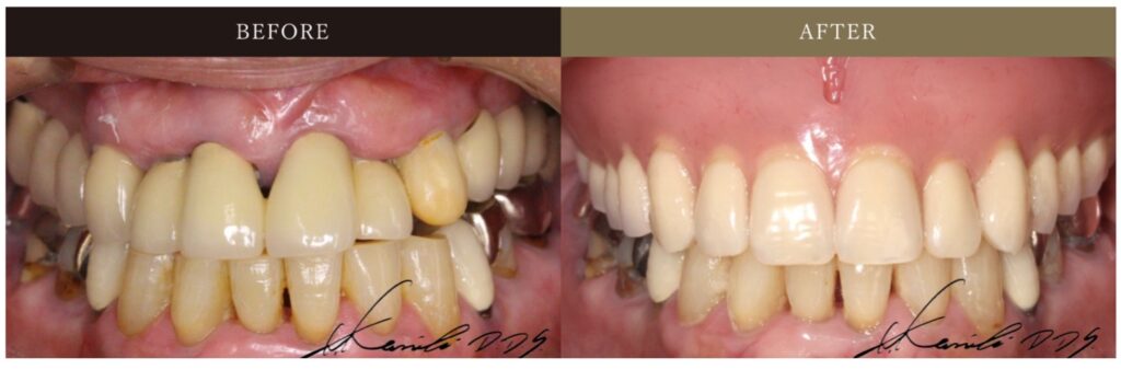 50代女性のテレスコープ義歯(ドイツ式入れ歯)の治療例の詳細