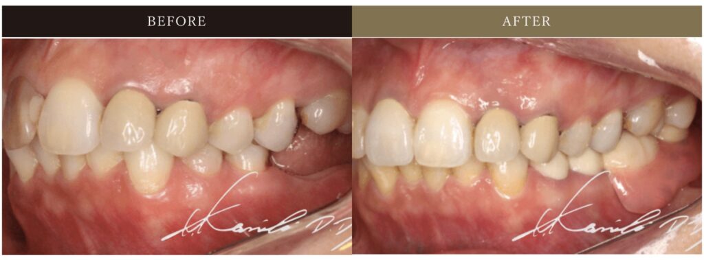 リーゲルテレスコープ義歯の症例