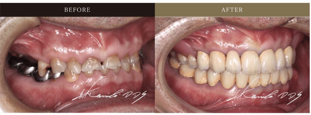 入れ歯の外れる悩みが消える症例集