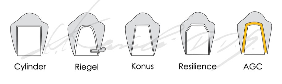 ドイツ式入れ歯(テレスコープ義歯)の種類