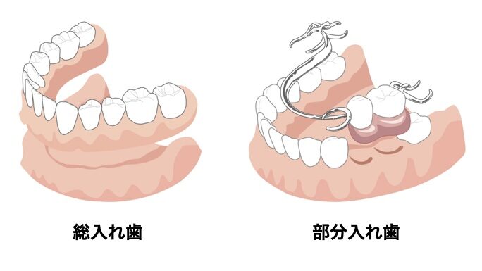 部分入れ歯と総入れ歯の違い