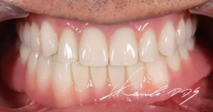 下あごはドイツ式入れ歯(テレスコープ義歯)のコーヌステレスコープ、上あごは総入れ歯で治療した口の中の状態