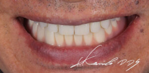 下あごはドイツ式入れ歯(テレスコープ義歯)のコーヌステレスコープ、上あごは総入れ歯で治療した見た目