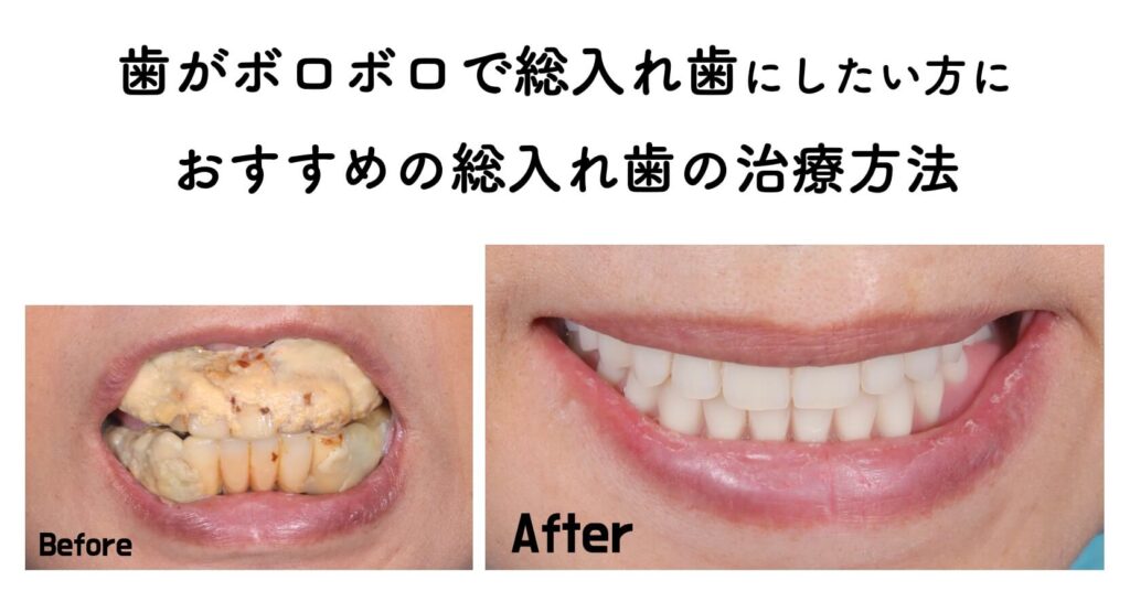 歯がボロボロで総入れ歯にしたい