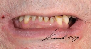 50代男性のドイツ式入れ歯の治療前の見た目