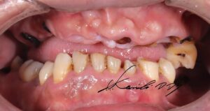 50代男性のドイツ式入れ歯の治療前の状態