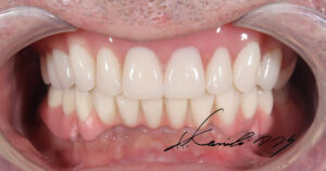 50代男性のドイツ式入れ歯の治療後の状態