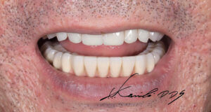 50代男性のドイツ式入れ歯の治療後の見た目