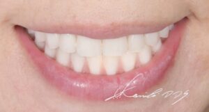 50代女性の入れ歯のきれいな見た目