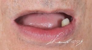 歯がボロボロ、グラグラの方の治療前の見た目