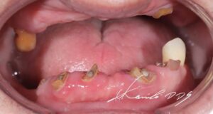 歯がボロボロ、グラグラの方の治療前