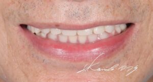 歯がボロボロ、グラグラの方の仮義歯を入れた見た目