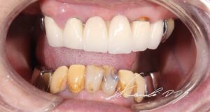 ドイツ式入れ歯（テレスコープ義歯）の治療前