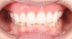 ドイツ式入れ歯（テレスコープ義歯）の仮歯の治療後