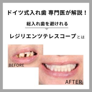 レジリエンツテレスコープとは|メリット・寿命・費用・症例を専門医が解説