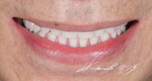 レジリエンツテレスコープで治療した状態