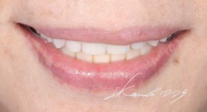 レジリエンツテレスコープの見た目