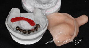 ドイツ式入れ歯（テレスコープ義歯）の外冠の型取りの様子