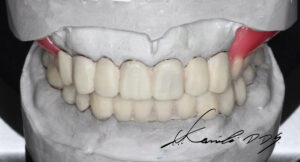 ドイツ式入れ歯（テレスコープ義歯）の完成前の状態