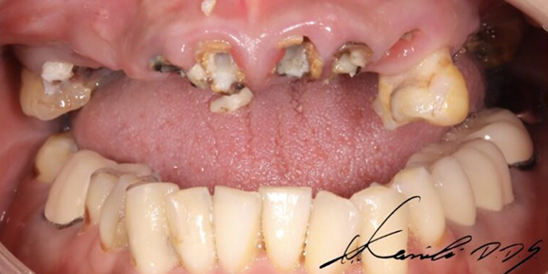 歯がボロボロになってしまった方へ