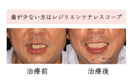 歯が弱い方はレジリエンツテレスコープ