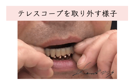 テレスコープの外し方、外すところ