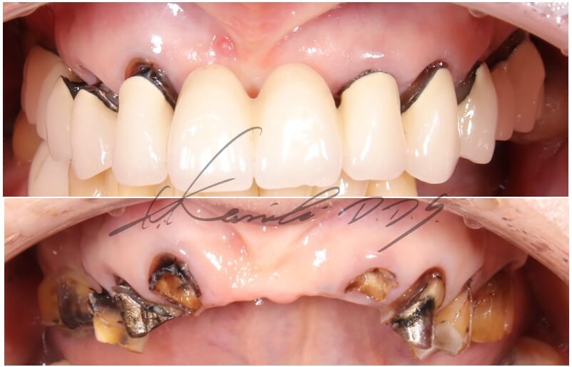 ブリッジがとれそうな状態でブリッジがとれた状態