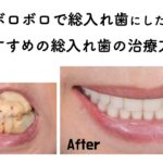 歯がボロボロで総入れ歯にしたい