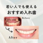 若い人でも使えるおすすめ入れ歯