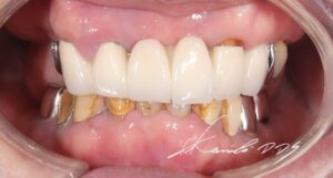 60代で総入れ歯を回避できた症例の治療前