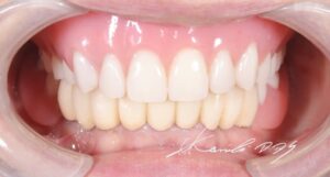 60代で総入れ歯を回避できた症例の治療後