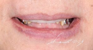 60代で総入れ歯を回避できた症例の治療前の見た目