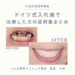 ドイツ式入れ歯の症例集まとめ