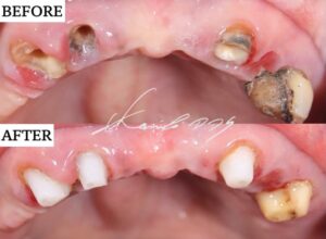 60代で総入れ歯を回避できた症例のブリッジを外した直後の状態と治療した直後の比較