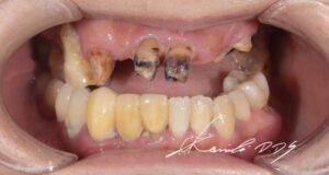 ブリッジがダメになったときの歯の状態