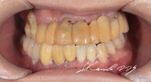 ブリッジがとれそうな状態